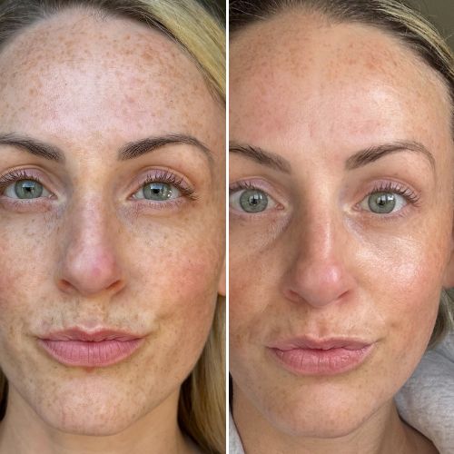 deux photos de mon contour des yeux prises à deux mois d’intervalle, dans les mêmes conditions de lumière, pour comparer honnêtement l’évolution de mes ridules avant et après la cure.