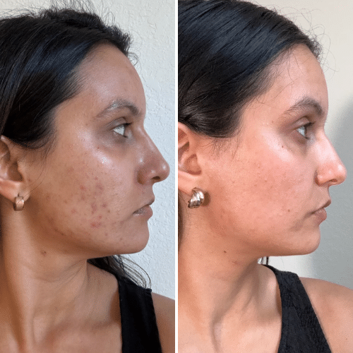 deux photos de mon menton prises à six semaines d’intervalle, dans les mêmes conditions de lumière, pour comparer honnêtement l’évolution de mes boutons inflammés et de mon teint sur cette zone.
